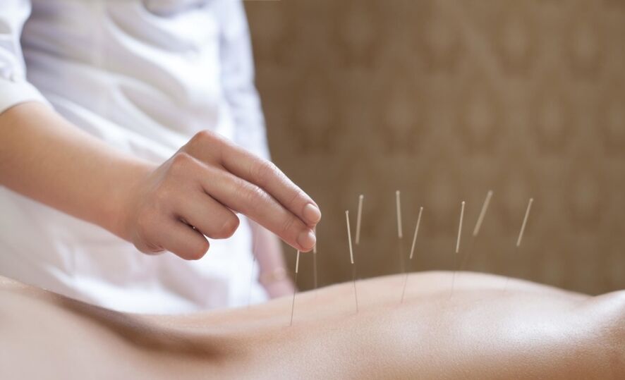acupuntura